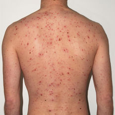 Avaderma Skin & Hair Clinic - Varicella (Chickenpox)